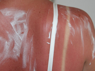 Prekomerno izlaganje SUNCU uzrokuje OŠTEĆENJA na koži: Evo kako da je TRETIRATE i vratite joj hidriranost i SJAJ