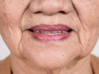 Zubar upozorava: Nikad ne ignorišite suva USTA, mogu da budu simptom ozbiljnih bolesti"