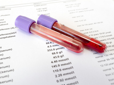 Vaša krvna slika nije u redu ukoliko pokazuje ovo: Doktor otkrio kako se čita nalaz biohemije