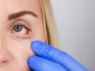 Simptom NAJSMRTONOSNIJEG tumora može da se vidi povlačenjem očnog KAPKA: Ovu opasnu bolest najbitnije je na vreme UOČITI