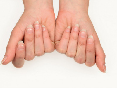 Šta znače bele mrlje na vašim noktima? Evo kada treba da se zabrinete