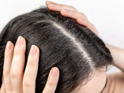 Ako ne možete da se otarasite PERUTI i MASNE kose, probajte OVO: Pomešajte šampon sa ovim uljima, rezultat je neverovatan