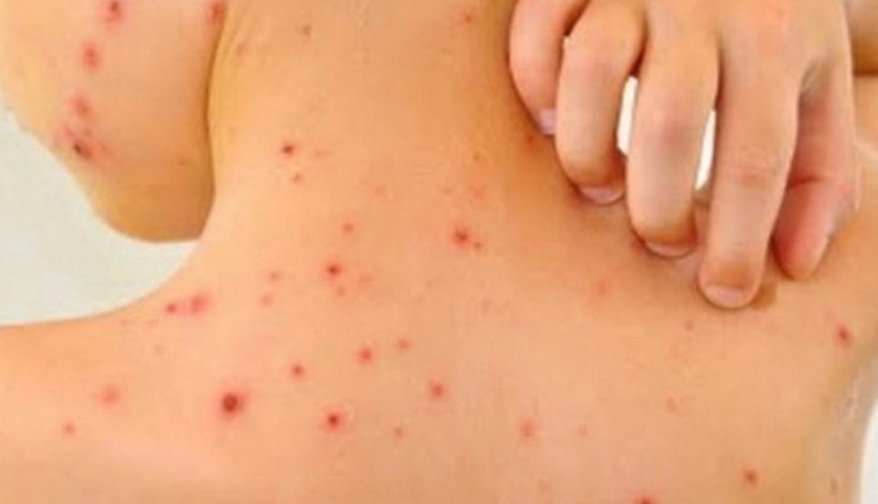 Deca to ne mogu da sakriju; Ovo su siptomi VARIČELA pre nego što izbiju na površinu kože: Obratite pažnju!