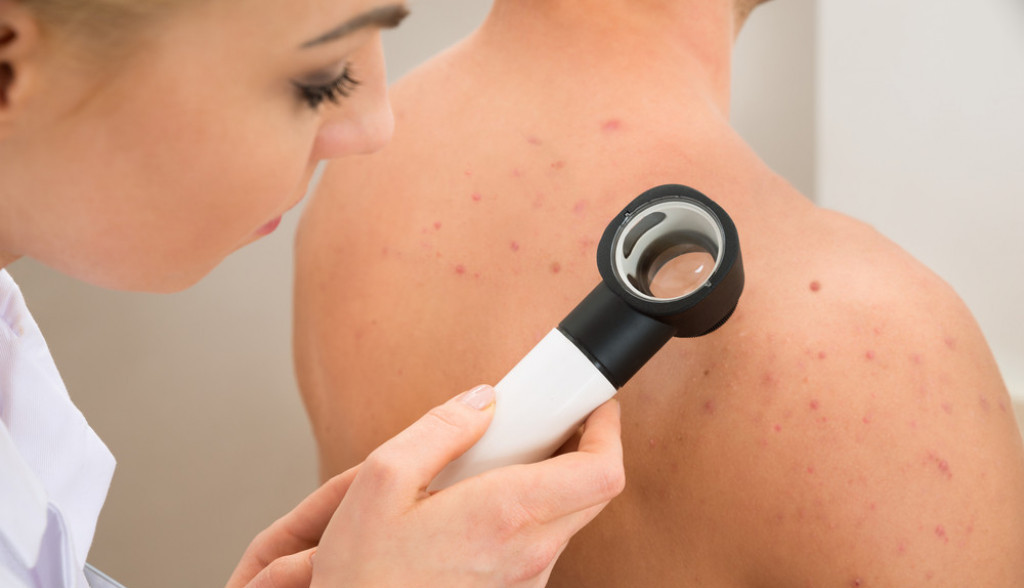 Ovako NASTAJU bubuljice na leđima: Dermatolozi OTKRIVAJU kako ih se rešiti za SVA VREMENA