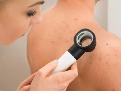 Ovako NASTAJU bubuljice na leđima: Dermatolozi OTKRIVAJU kako ih se rešiti za SVA VREMENA