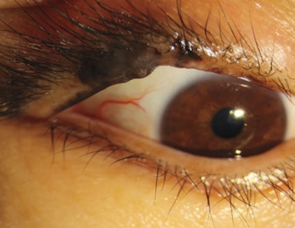 Često vas SVRBI oko? Ovaj bezazleni SIMPTOM može da bude znak opasne bolesti