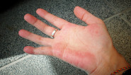 Ako imate CRVENE dlanove, ODMAH izvadite KRV: Bezazlen simptom upozorava da vam jedan ORGAN OTKAZUJE – brzo reagujte!