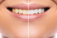 Sve što boji ODEĆU boji i zube: Dermatolog otkrio koje namirnice moramo da IZBEGAVAMO