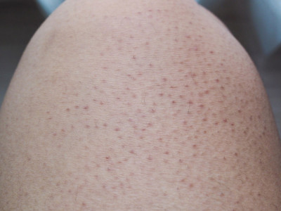 Rešite se TAMNIH tačkica na nogama koje se javljaju nakon brijanja: Tajna je u OVIM koracima, koža će biti glatka