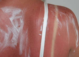 Prekomerno izlaganje SUNCU uzrokuje OŠTEĆENJA na koži: Evo kako da je TRETIRATE i vratite joj hidriranost i SJAJ