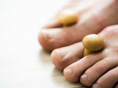 Gljivice na noktima mogu ozbiljno narušiti zdravlje: Ova tri domaća leka uspešno suzbijaju infekciju! (RECEPT)