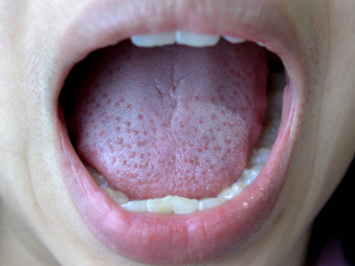Ove simptome morate da shvatite ozbiljno: Ako vam TRNE jezik, HITNO kod lekara!
