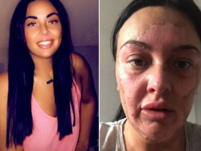 Devojka SPALILA lice zbog TRIKA na društvenim mrežama: Mesecima se oporavlja, UPOZORILA sve devojke da se paze!