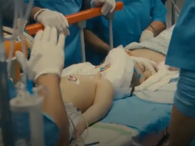 Glave su im bile SPOJENE: Nakon više od 25 sati na operacionom stolu, lekari su uspeli da razdvoje SIJAMSKE blizance (VIDEO)