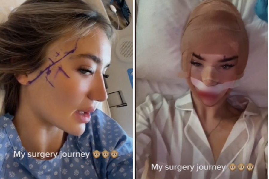Otišla je u Tursku na plastičnu operaciju: Nastao je HAOS nakon što je skinula  zavoje sa glave