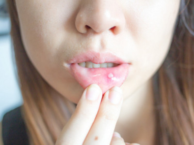 Šta ako vaše dete ima BELE i bolne RANICE u ustima? Možete im olakšati tegobe i kod kuće, evo šta da uradite