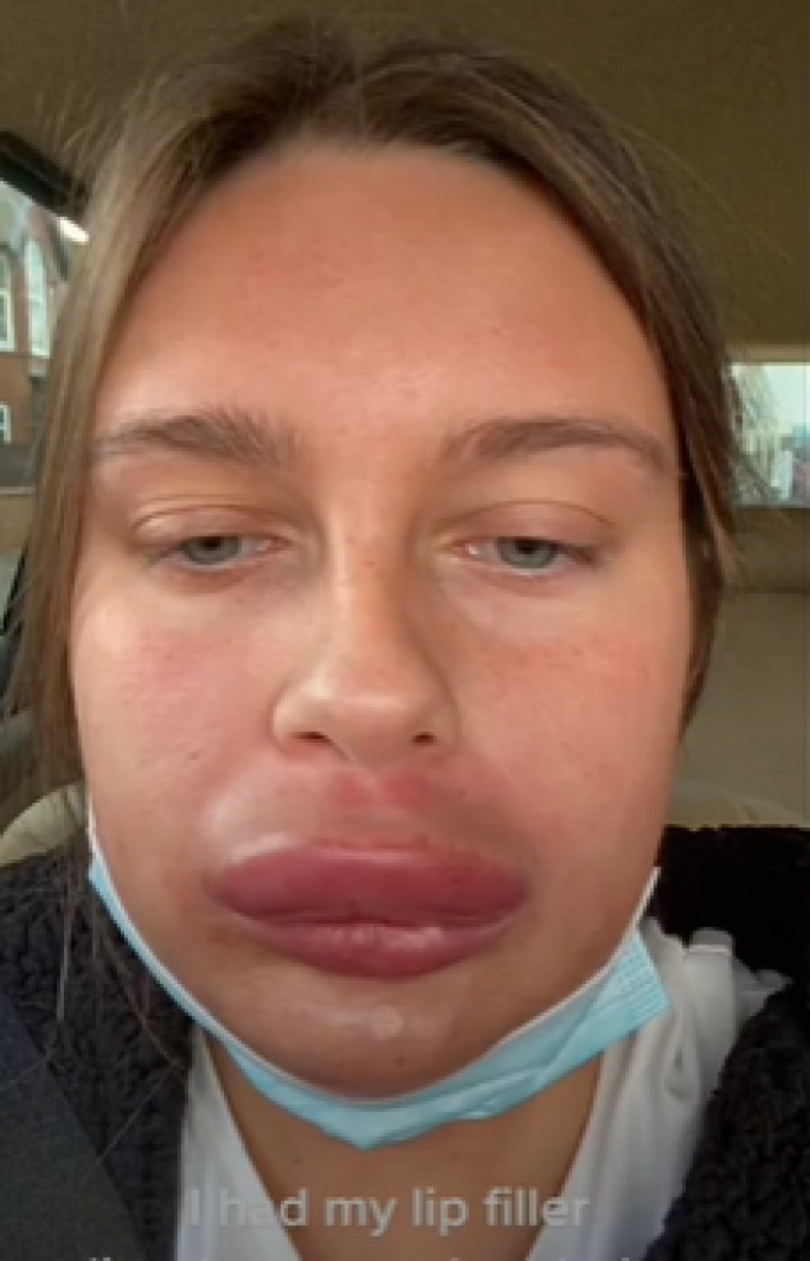 Doktori su joj jedva spasili ŽIVOT nakon korekcije usana: Vadila je filere i umalo UMRLA!