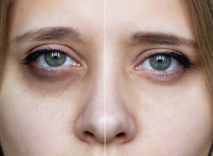 Otkrijte prirodni način za uklanjanje TAMNIH krugova ispod očiju: Ovaj tretman svako može da uradi kod kuće