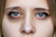 Otkrijte prirodni način za uklanjanje TAMNIH krugova ispod očiju: Ovaj tretman svako može da uradi kod kuće
